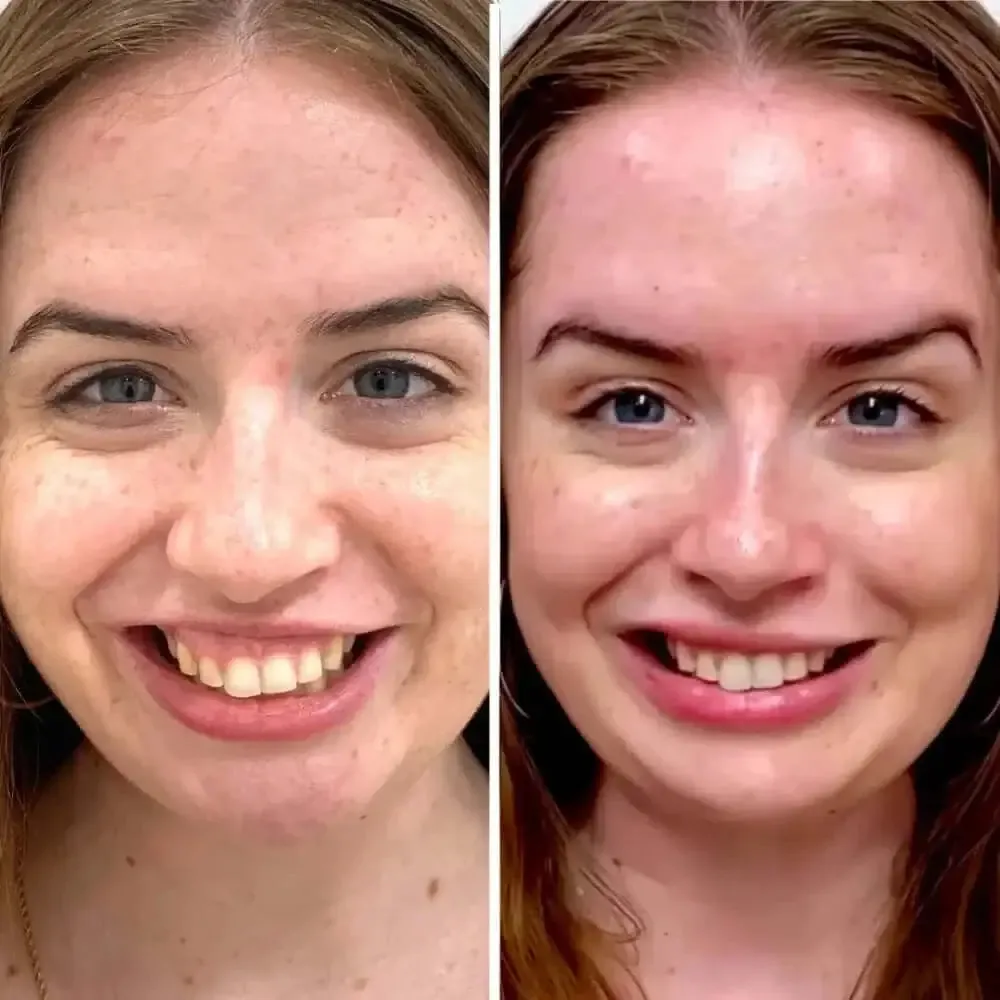 LipFix: Gummy Smile