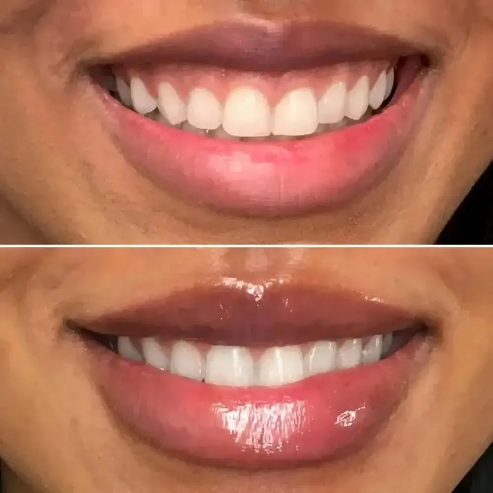 LipFix: Gummy Smile