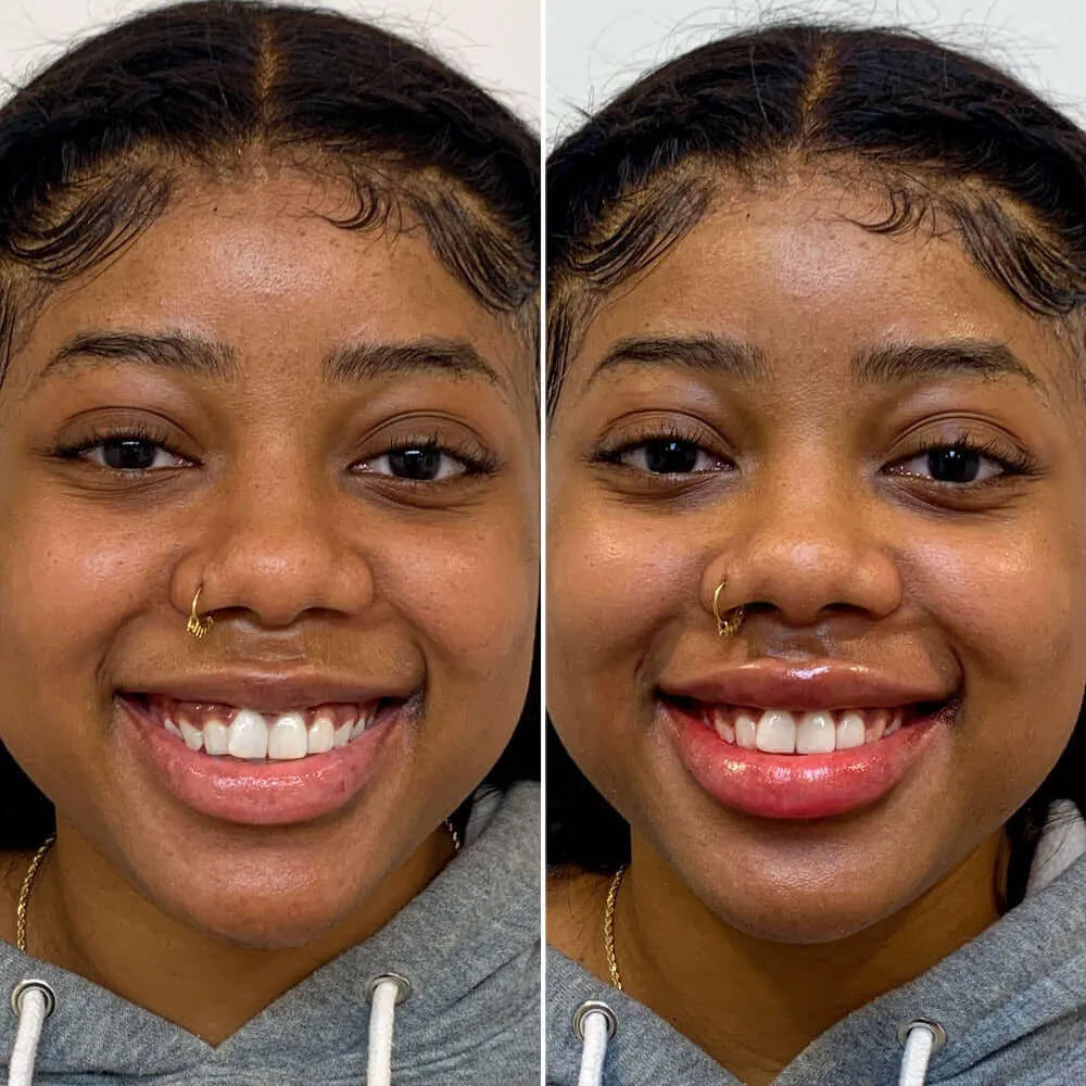LipFix: Gummy Smile