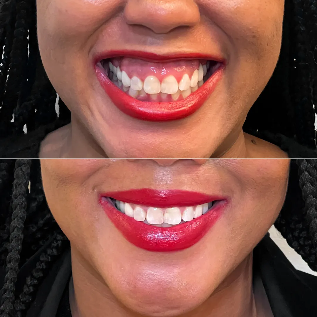LipFix: Gummy Smile